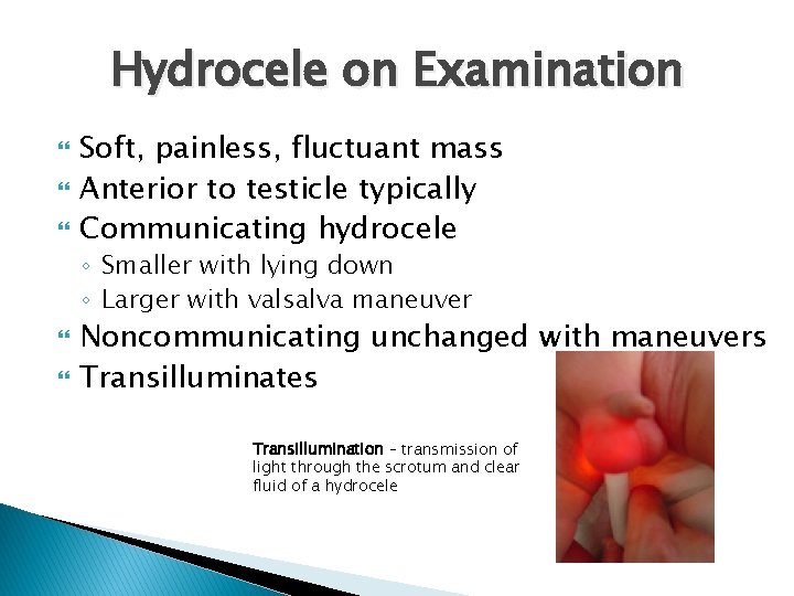 Hydrocele on Examination Soft, painless, fluctuant mass Anterior to testicle typically Communicating hydrocele ◦