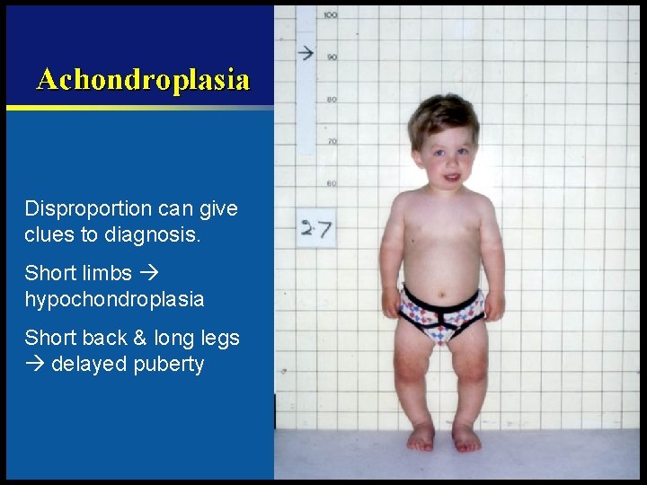 Disproportion can give clues to diagnosis. Short limbs hypochondroplasia Short back & long legs