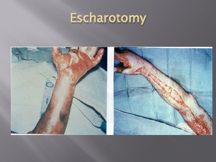 Escharotomy 