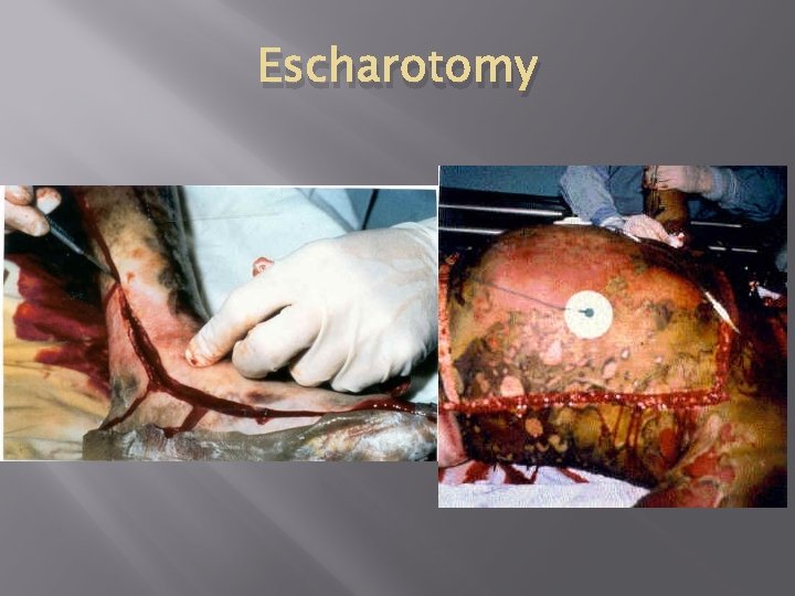 Escharotomy 