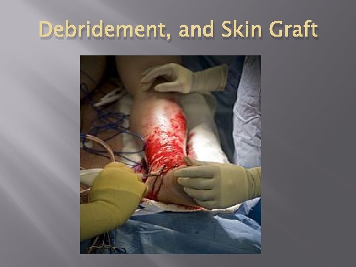 Debridement, and Skin Graft 