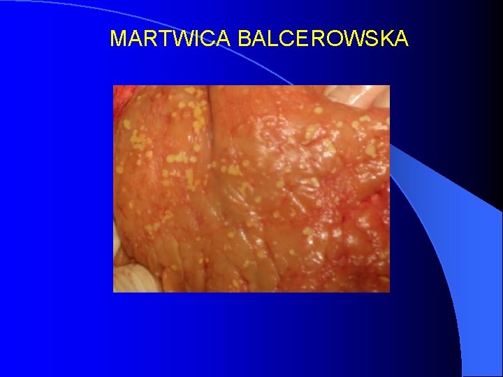 MARTWICA BALCEROWSKA 