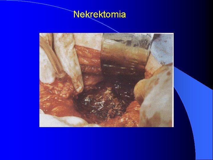 Nekrektomia 