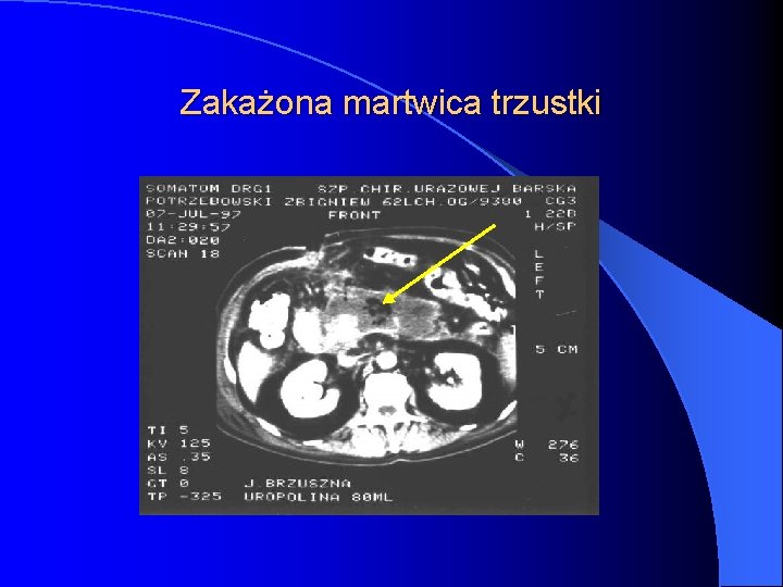 Zakażona martwica trzustki 