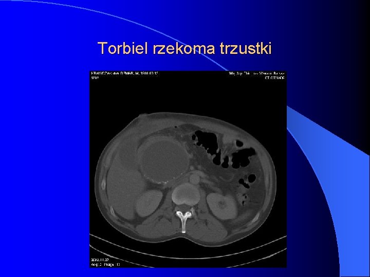 Torbiel rzekoma trzustki 