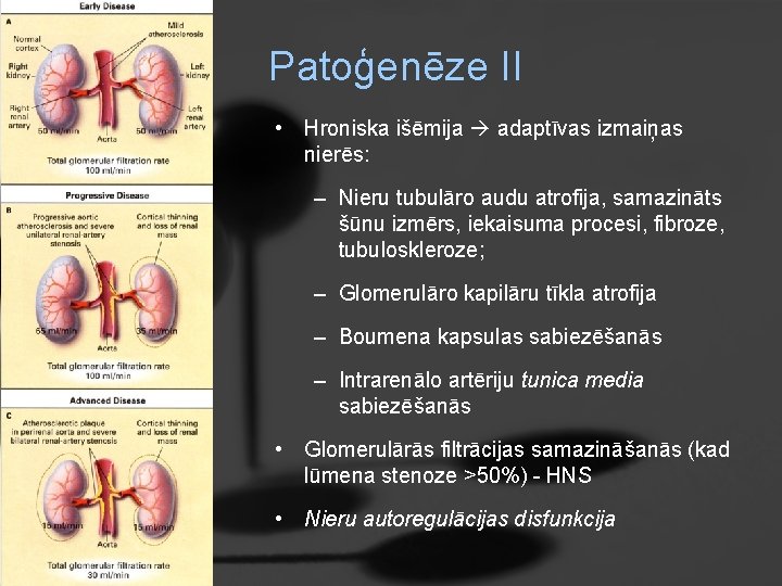 Patoģenēze II • Hroniska išēmija adaptīvas izmaiņas nierēs: – Nieru tubulāro audu atrofija, samazināts