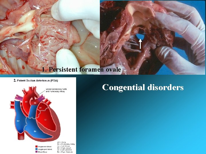1. Persistent foramen ovale 2. Congential disorders 