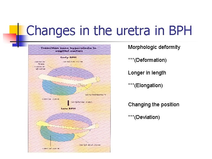 Changes in the uretra in BPH Morphologic deformity ***(Deformation) Longer in length ***(Elongation) Changing