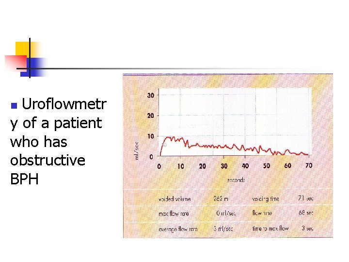 Uroflowmetr y of a patient who has obstructive BPH n 