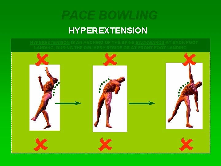 PACE BOWLING HYPEREXTENSION IS AN ARCHING OF THE SPINE BACKWARDS AT BACK FOOT LANDING,
