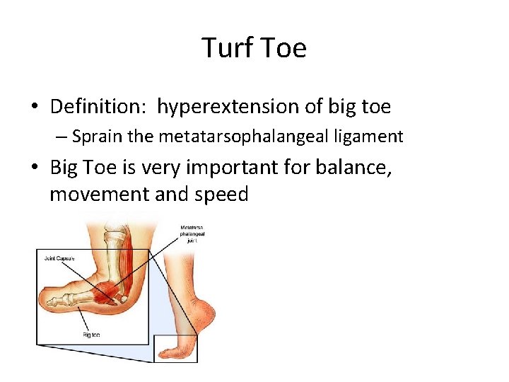 Turf Toe • Definition: hyperextension of big toe – Sprain the metatarsophalangeal ligament •