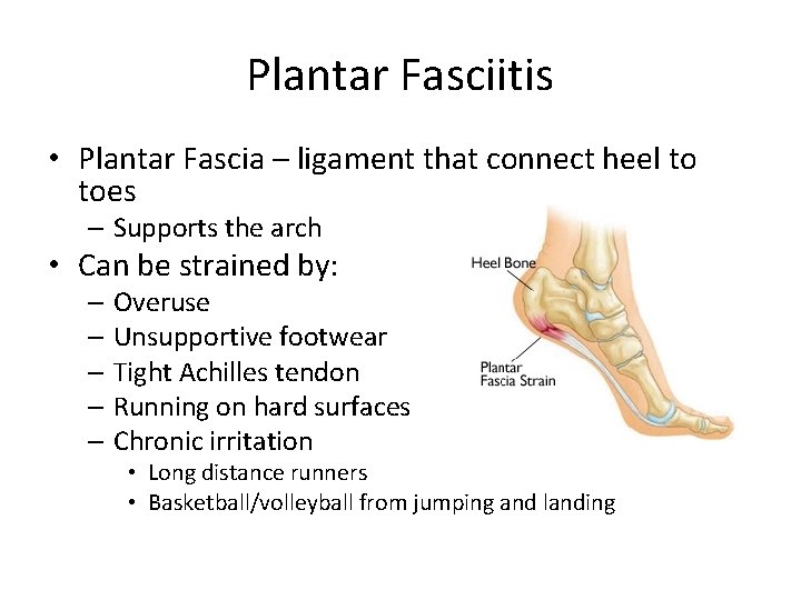 Plantar Fasciitis • Plantar Fascia – ligament that connect heel to toes – Supports