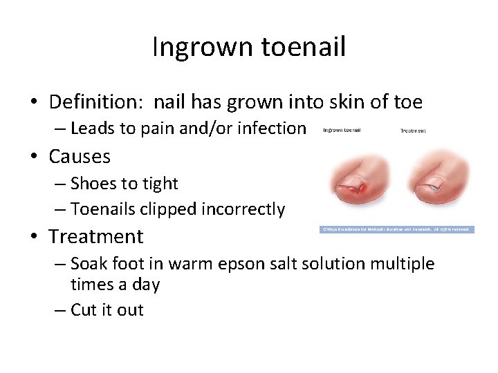 Ingrown toenail • Definition: nail has grown into skin of toe – Leads to
