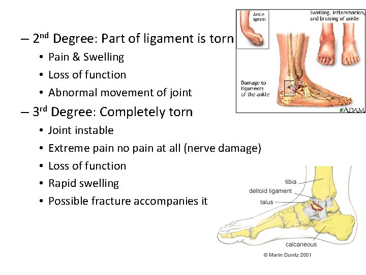 – 2 nd Degree: Part of ligament is torn • Pain & Swelling • – 2 nd Degree: Part of ligament is torn • Pain & Swelling •