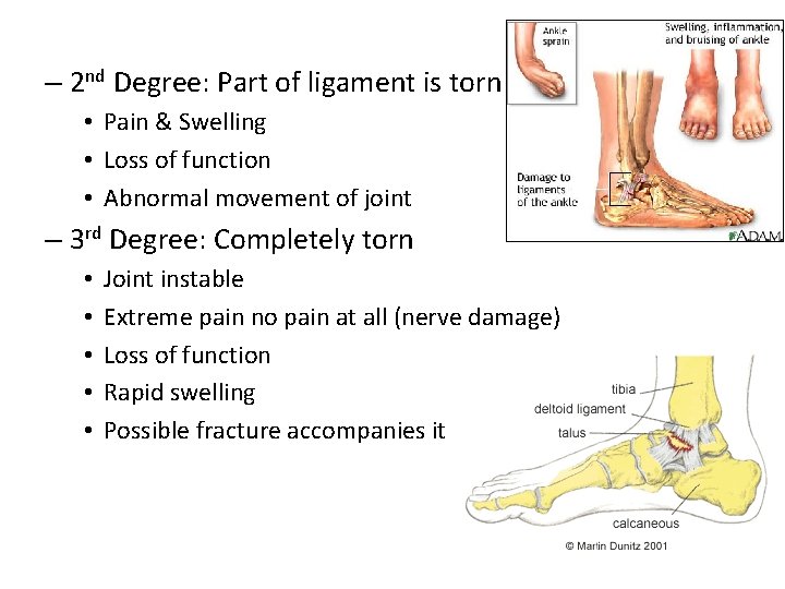 – 2 nd Degree: Part of ligament is torn • Pain & Swelling •