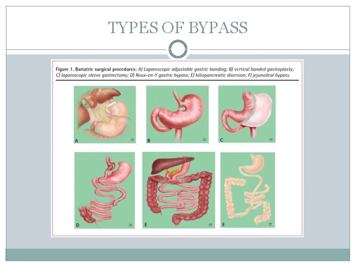 TYPES OF BYPASS 