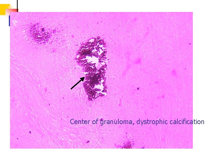 Center of granuloma, dystrophic calcification 