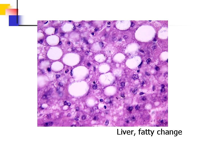 Liver, fatty change 