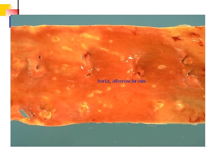 Aorta, atherosclerosis 