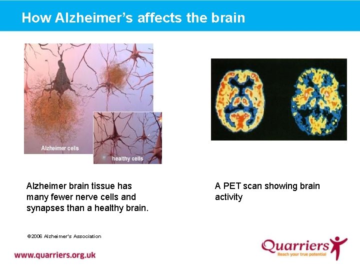 How Alzheimer’s affects the brain Alzheimer brain tissue has many fewer nerve cells and