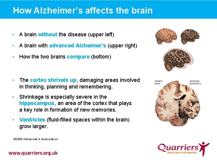 How Alzheimer’s affects the brain • A brain without the disease (upper left) •
