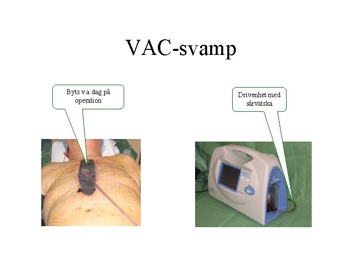 VAC-svamp Byts v. a dag på operation Drivenhet med sårvätska 