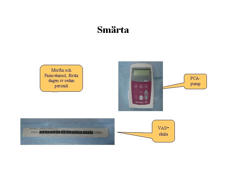 Smärta Morfin och Paracetamol, första dagen iv sedan peroralt PCApump - VAS skala 