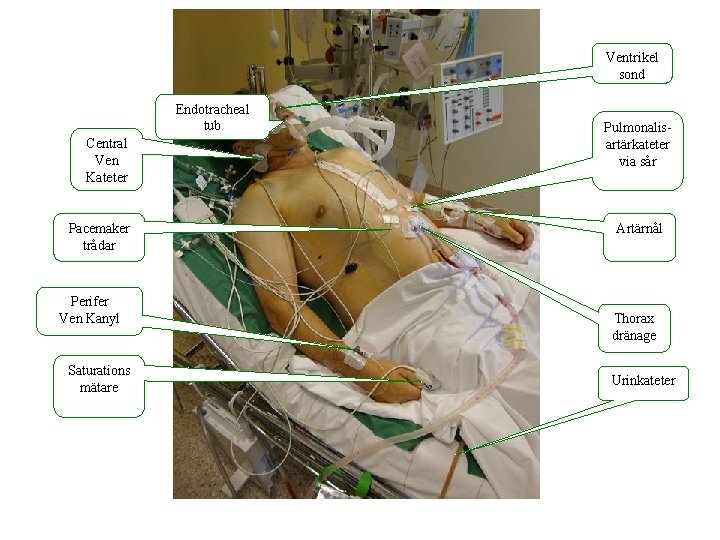 Ventrikel sond Endotracheal tub Central Ven Kateter Pacemaker trådar Perifer Ven Kanyl Saturations mätare