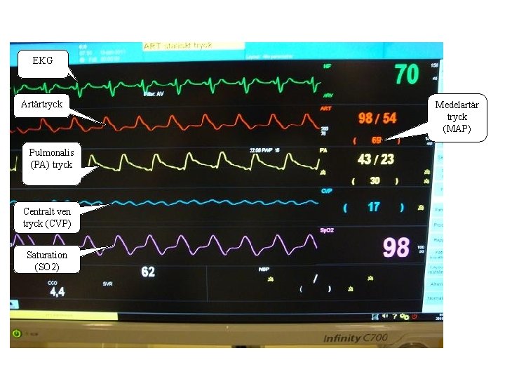 EKG Artärtryck Pulmonalis (PA) tryck Centralt ven tryck (CVP) Saturation (SO 2) Medelartär tryck