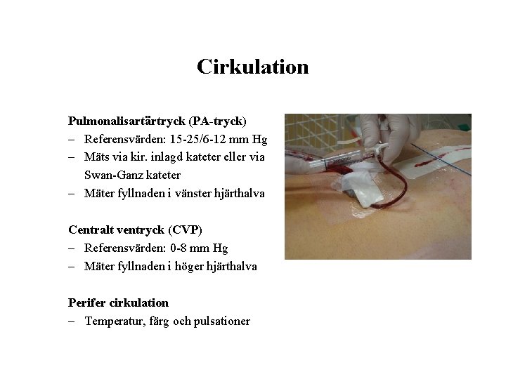 Cirkulation Pulmonalisartärtryck (PA-tryck) – Referensvärden: 15 -25/6 -12 mm Hg – Mäts via kir.