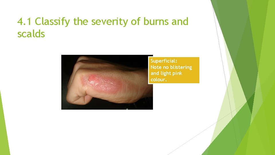 4. 1 Classify the severity of burns and scalds Superficial: Note no blistering and