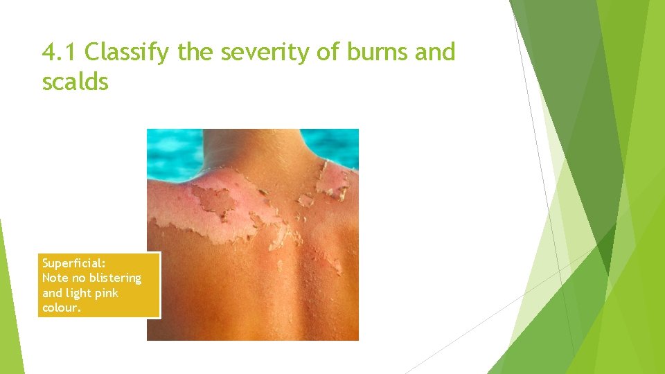 4. 1 Classify the severity of burns and scalds Superficial: Note no blistering and