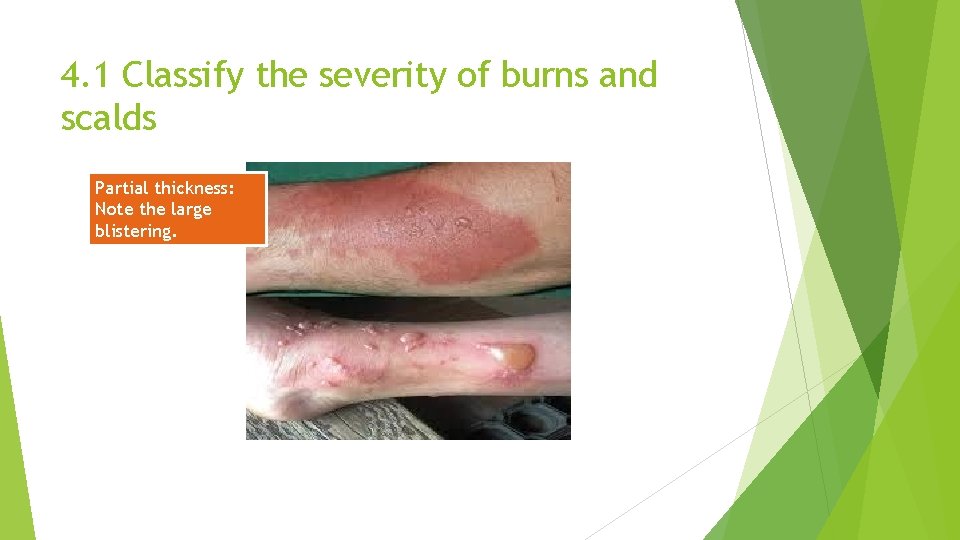 4. 1 Classify the severity of burns and scalds Partial thickness: Note the large