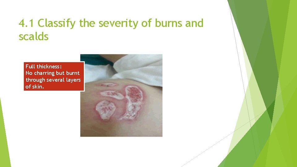 4. 1 Classify the severity of burns and scalds Full thickness: No charring but