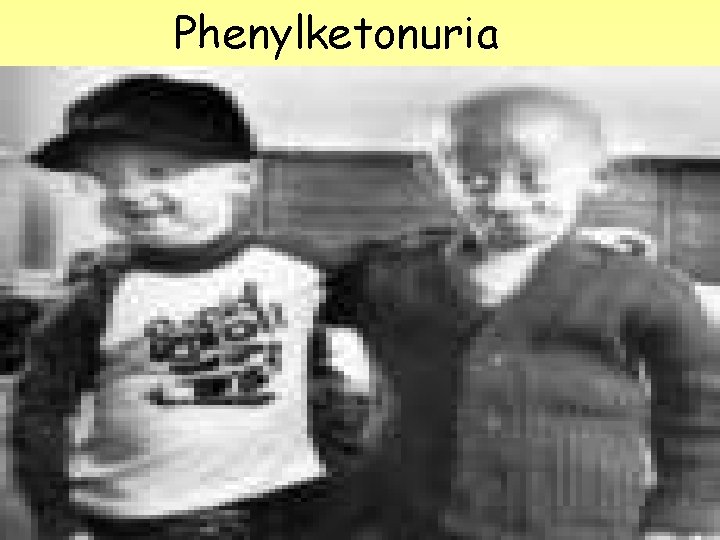 Phenylketonuria 