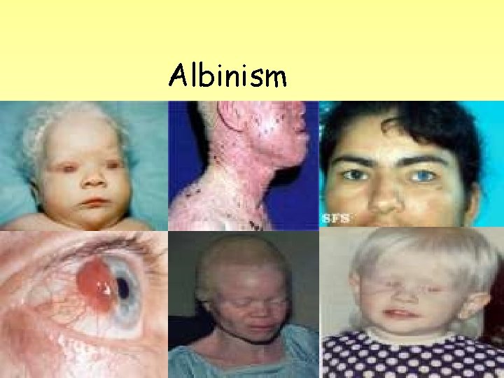 Albinism 