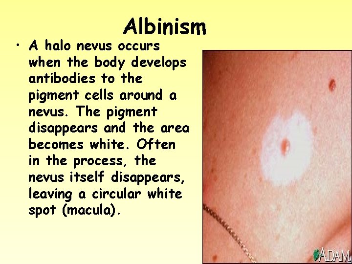 Albinism • A halo nevus occurs when the body develops antibodies to the pigment