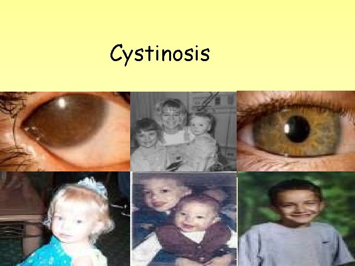 Cystinosis 