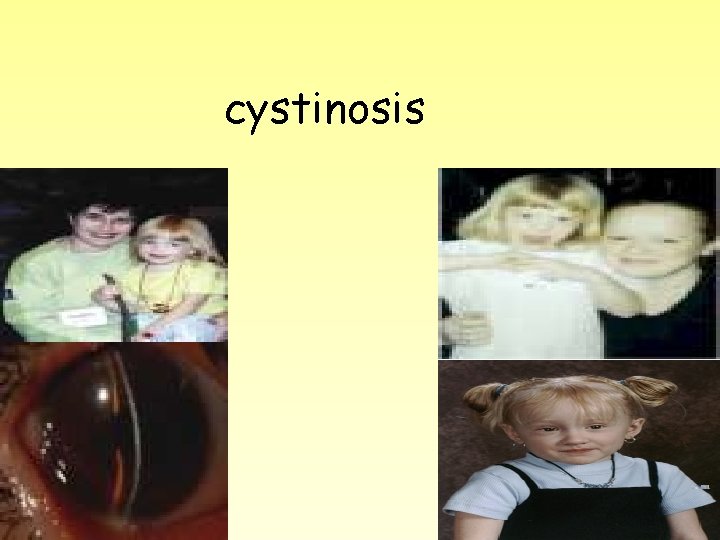 cystinosis 