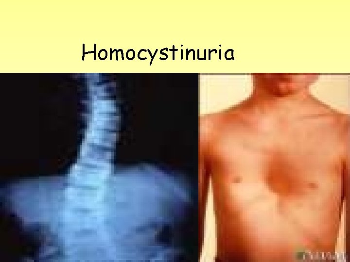 Homocystinuria 