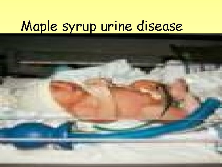 Maple syrup urine disease 