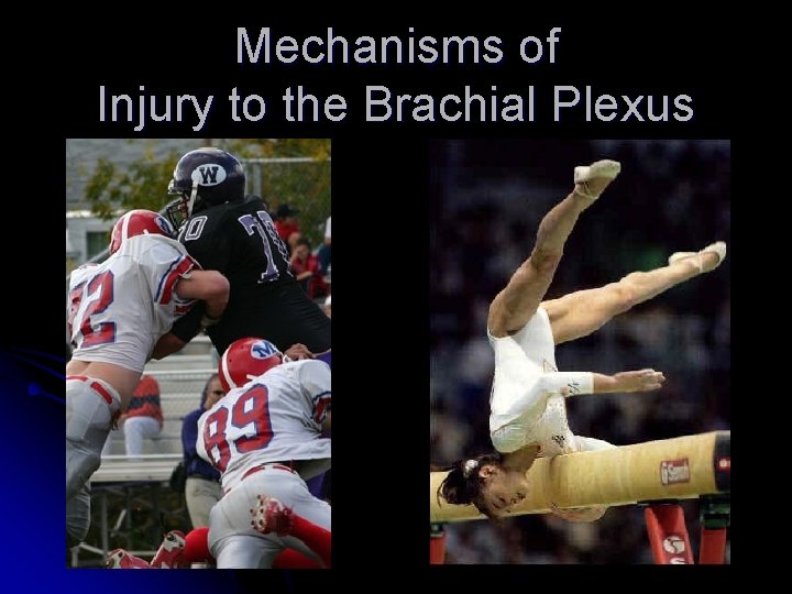Mechanisms of Injury to the Brachial Plexus 