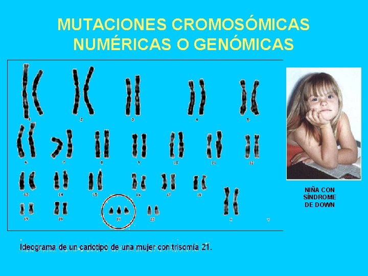 MUTACIONES CROMOSÓMICAS NUMÉRICAS O GENÓMICAS NIÑA CON SÍNDROME DE DOWN 