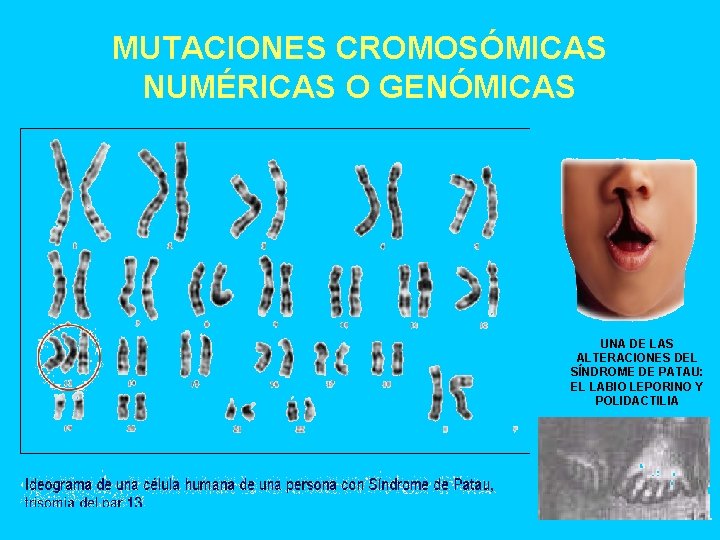 MUTACIONES CROMOSÓMICAS NUMÉRICAS O GENÓMICAS UNA DE LAS ALTERACIONES DEL SÍNDROME DE PATAU: EL