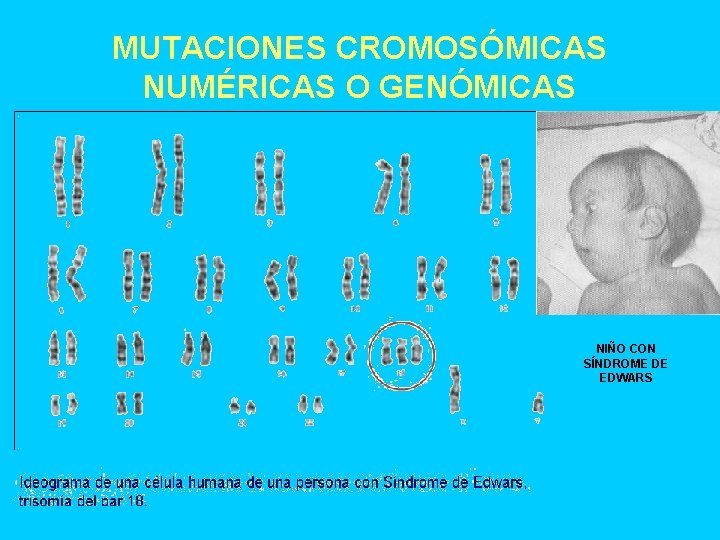 MUTACIONES CROMOSÓMICAS NUMÉRICAS O GENÓMICAS NIÑO CON SÍNDROME DE EDWARS 