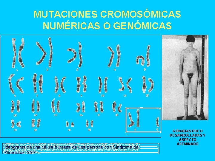 MUTACIONES CROMOSÓMICAS NUMÉRICAS O GENÓMICAS GÓNADAS POCO DESARROLLADAS Y ASPECTO AFEMINADO 