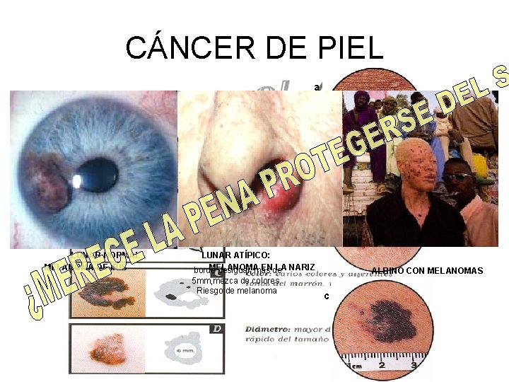 CÁNCER DE PIEL a MELANOMAS: b LUNAR NORMAL MELANOMA DE IRIS LUNAR ATÍPICO: MELANOMA