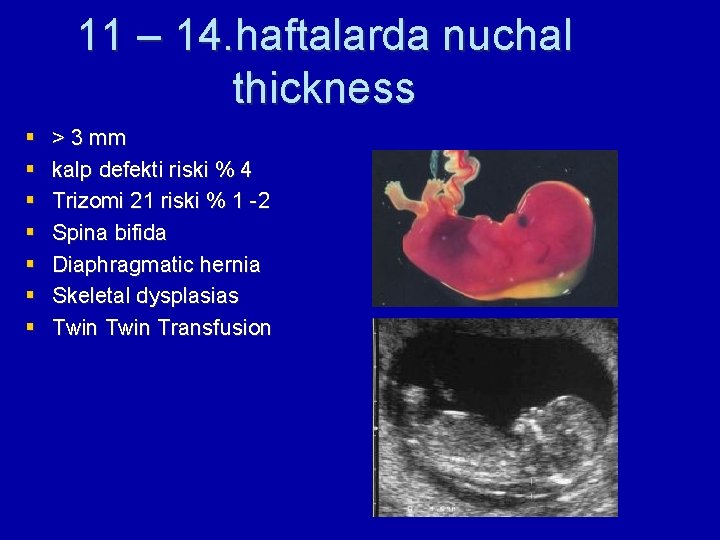 11 – 14. haftalarda nuchal thickness § § § § > 3 mm kalp