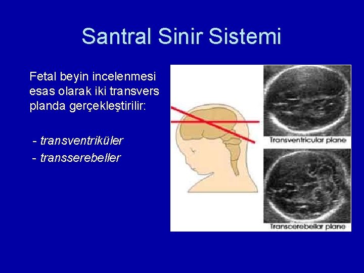 Santral Sinir Sistemi Fetal beyin incelenmesi esas olarak iki transvers planda gerçekleştirilir: - transventriküler