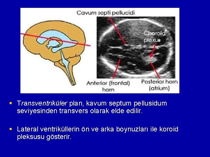 § Transventriküler plan, kavum septum pellusidum seviyesinden transvers olarak elde edilir. § Lateral ventriküllerin